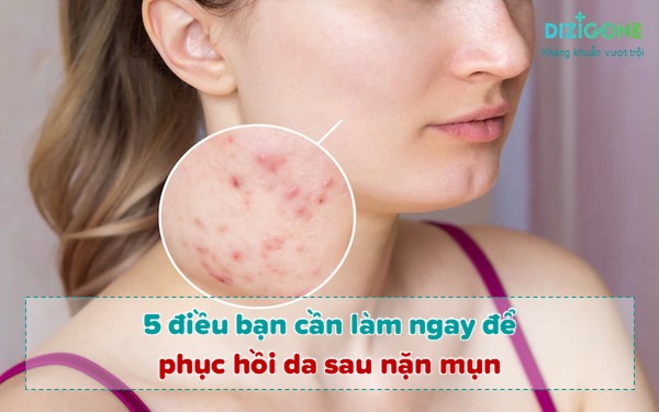 Mới Nặn Mụn Xong Nên Làm Gì? Gallery 1