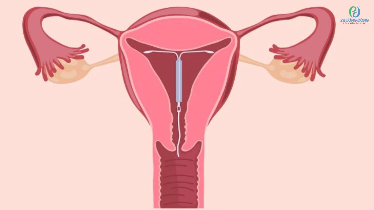 Làm sao để biết vòng tránh thai bị lệch?