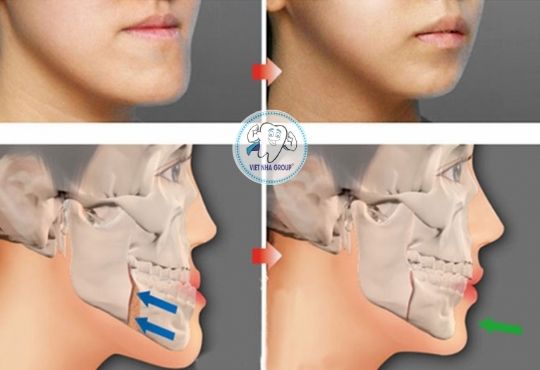 Làm Sao Để Hết Móm Tại Nhà?