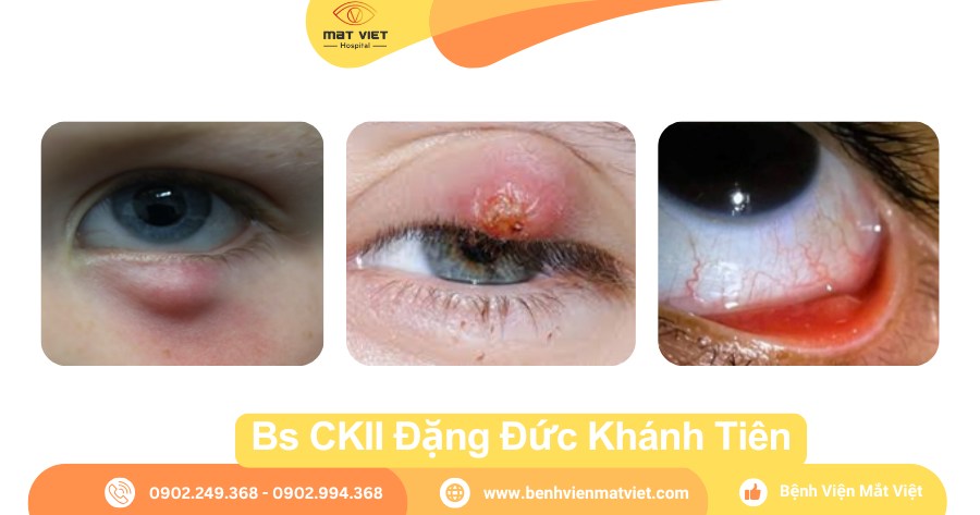 Chắp mắt bao lâu thì khỏi? Gallery 2