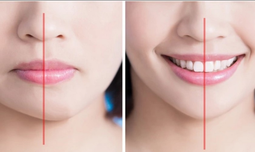 Mặt bên trái to hơn bên phải thì nằm nghiêng bên nào? Gallery 2