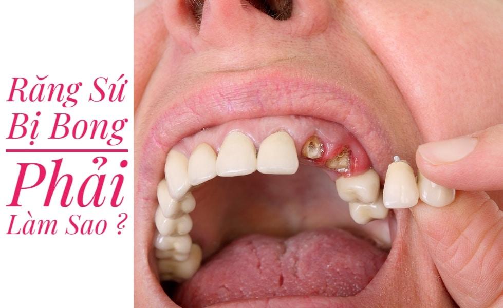 Bọc răng sứ có bị rơi ra không? Gallery 2