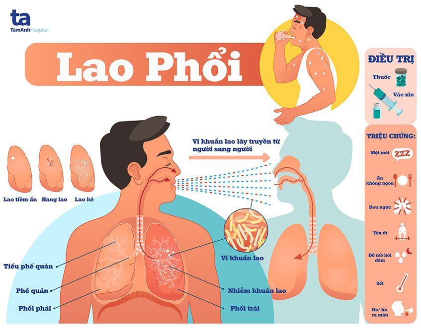 Lao Phổi Là Gì?