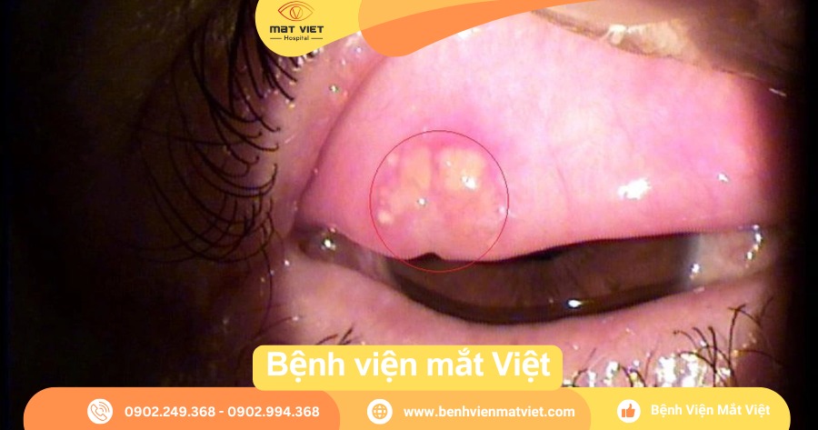 Lấy sạn vôi trong mắt