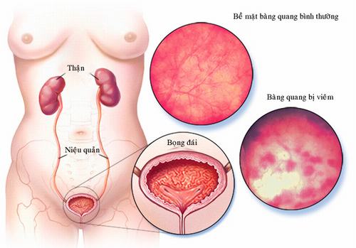 LEU là chỉ số gì?