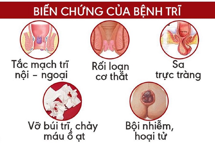 Nguyên nhân gây bệnh trĩ là gì? Gallery 2