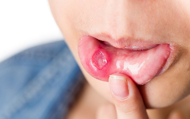 Nguyên nhân gây nhiệt miệng là gì?