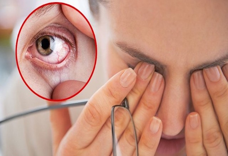 Liếc mắt bị đau: Nguyên nhân, triệu chứng và cách điều trị