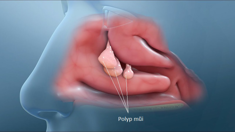 Lỗ mũi bị hôi: Nguyên nhân và cách khắc phục
