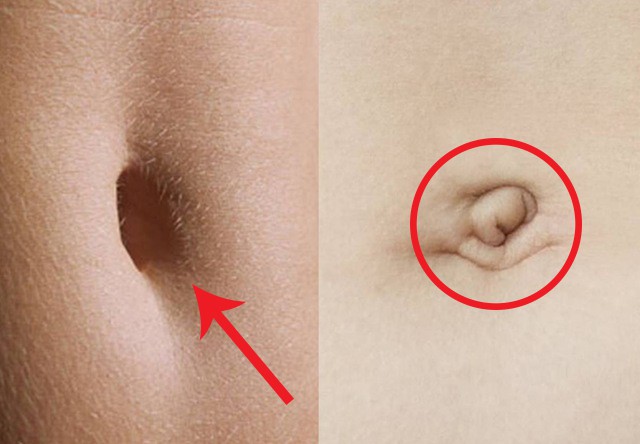 Lỗ Rốn To Rộng: Nguyên Nhân và Điều Trị