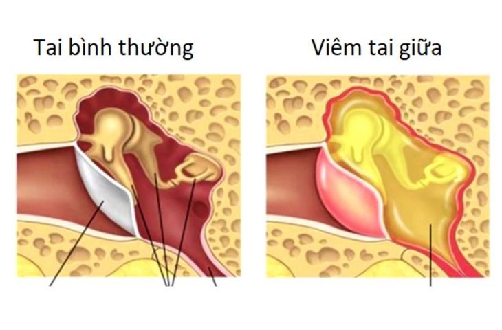 Lỗ Tai Bị Nhức: Nguyên Nhân, Triệu Chứng Và Cách Điều Trị