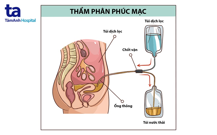 Lọc màng bụng là gì?