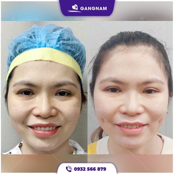 Có Nên Làm Má Lúm Đồng Tiền Không? Gallery 1