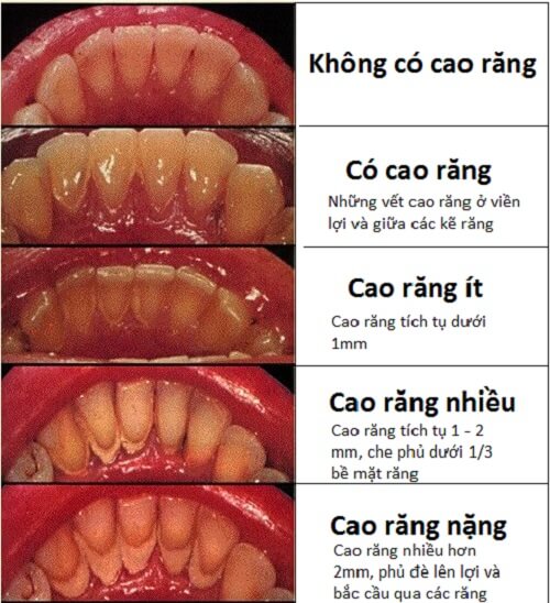 Có Nên Lấy Vôi Răng Không? Gallery 1