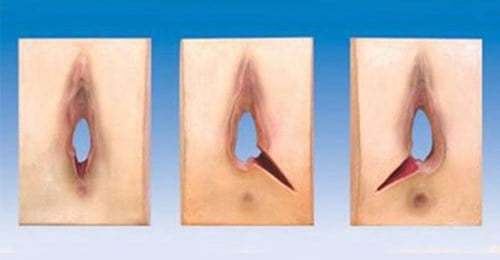 Đẻ thường có phải rạch không? Gallery 2