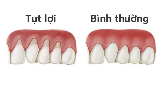 Lợi mỏng lộ chân răng