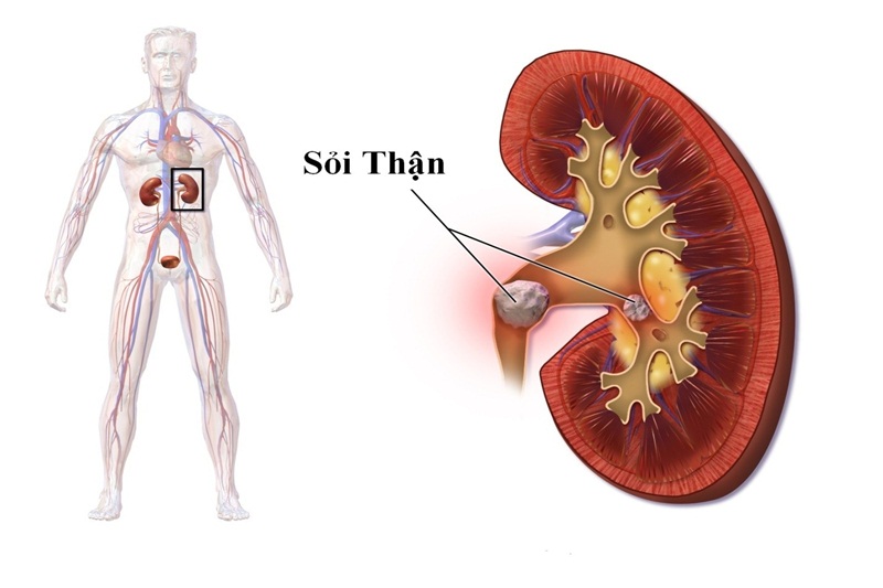 Lỏi Sỏi Là Gì?