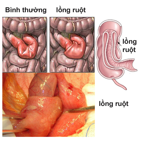 Lộn Ruột Nghĩa Là Gì?