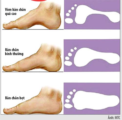 Lòng bàn chân bằng phẳng: Sướng hay khổ?