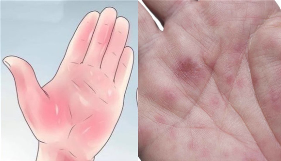 Lòng bàn tay nổi đốm trắng: Nguyên nhân, triệu chứng và cách điều trị