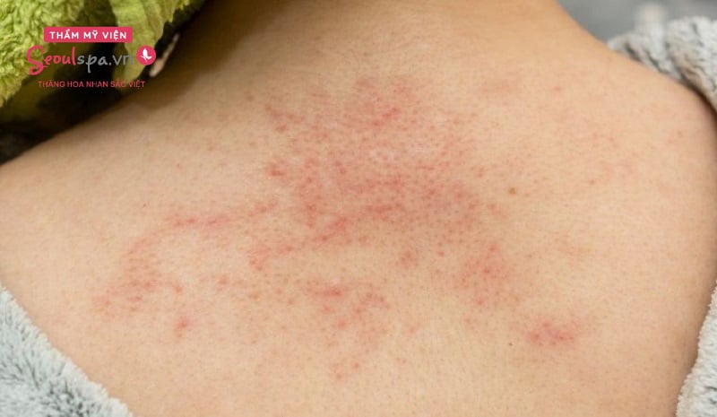 Lông măng ở lưng người lớn: Nguyên nhân, cách xử lý và điều cần biết
