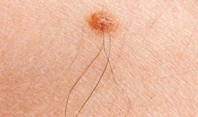 Lông Mọc Ở Núi Đôi: Nguyên Nhân Và Cách Xử Lý