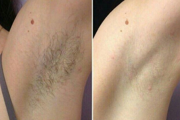 Lông nách mọc nhanh và nhiều: Nguyên nhân và cách khắc phục