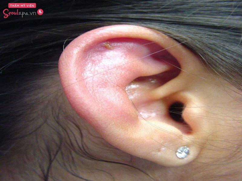 Lông Tai Mọc Dài: Nguyên Nhân, Cách Khắc Phục và Điều Trị