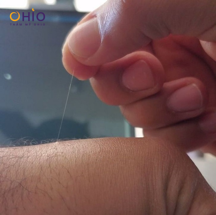 Lông tơ trắng mọc dài: Nguyên nhân và cách xử lý