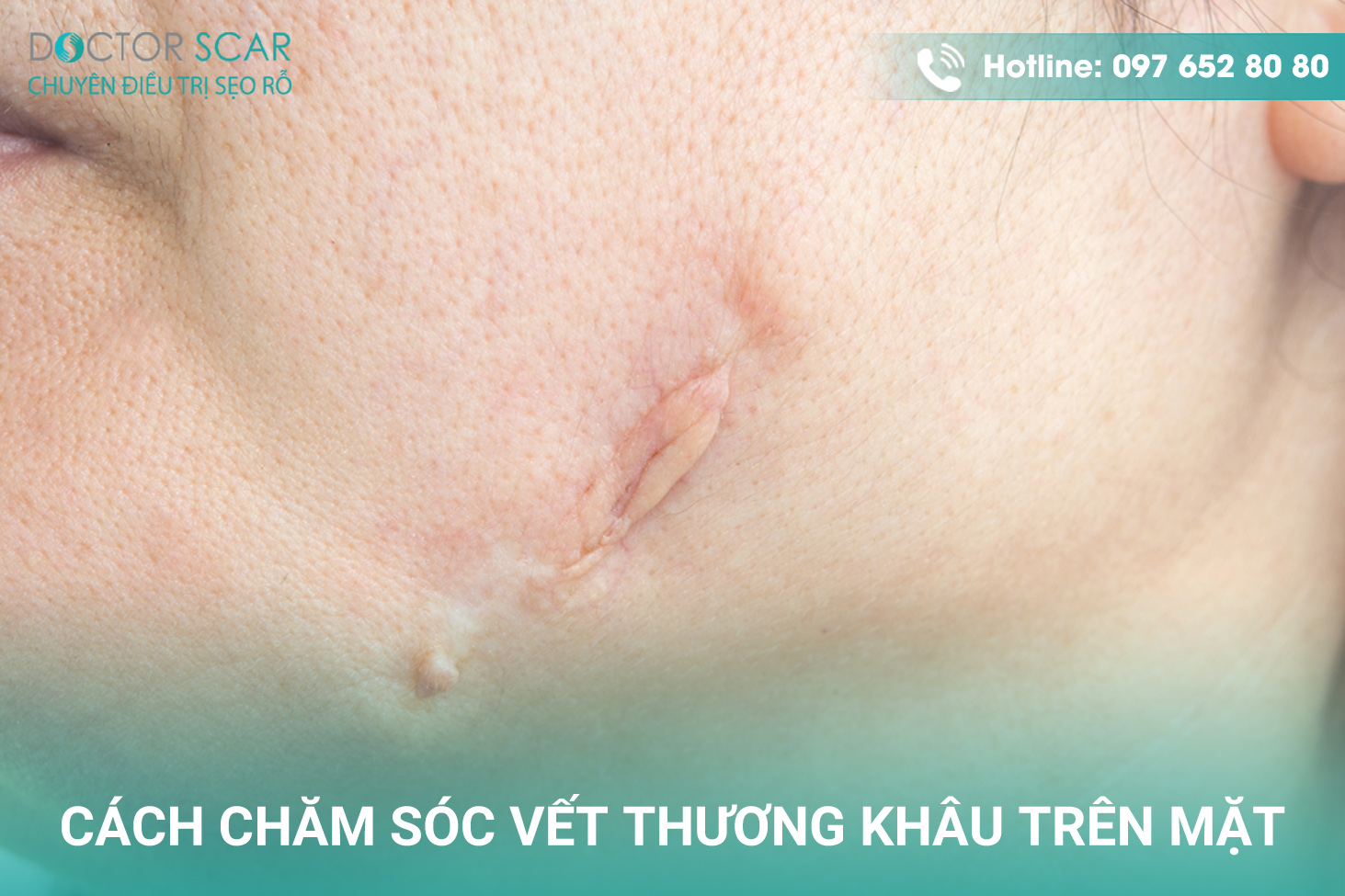 Trị Sẹo Vết Khâu Trên Mặt Hiệu Quả Gallery 2
