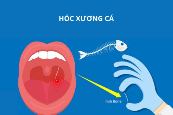 Gắp xương cá ở đâu? Gallery 2