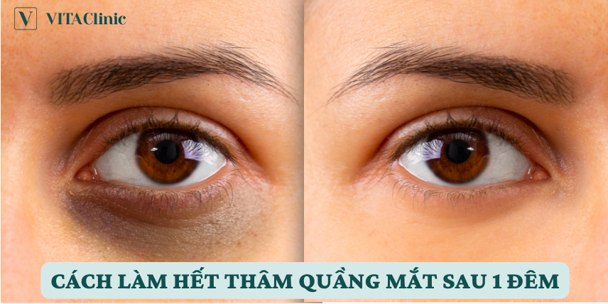 Cách Làm Hết Thâm Quầng Mắt Sau 1 Đêm Tại Nhà Gallery 2