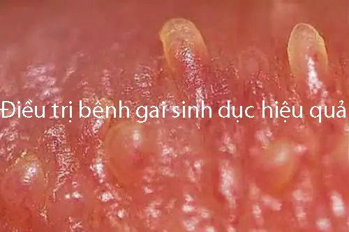 Gai Sinh Dục Thường Mọc Ở Đâu? Gallery 2