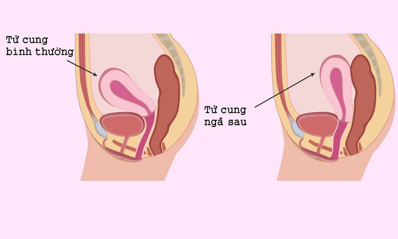 Kiểu Quan Hệ Cho Tử Cung Ngả Sau Gallery 2