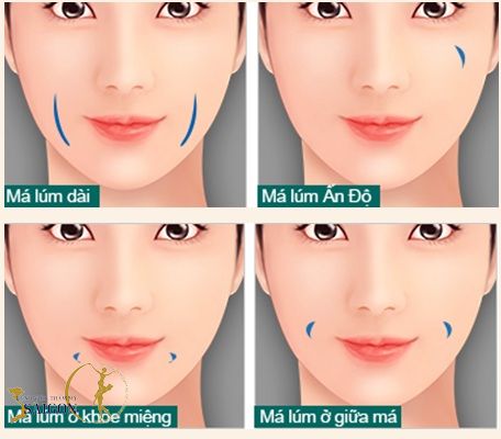 Má lúm ở dưới miệng