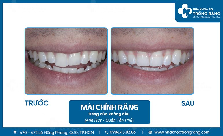 Mài Răng Cửa Ngắn Lại
