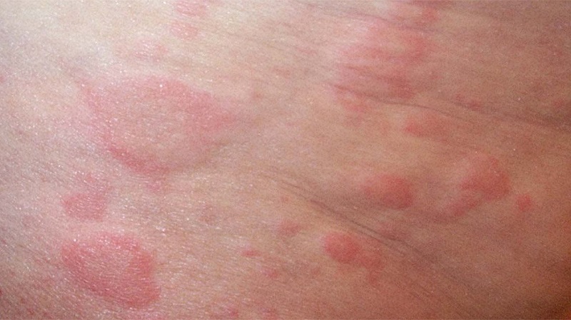 Mẩn Ngứa Nổi Cục: Nguyên Nhân và Cách Điều Trị