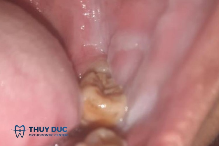 Mảng trắng trong miệng sau khi đánh răng: Nguyên nhân và cách khắc phục