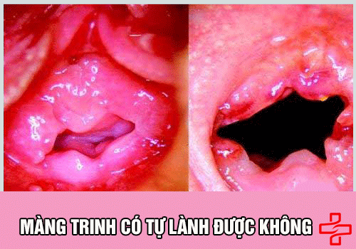 Màng trinh có lành lại được không? Gallery 2
