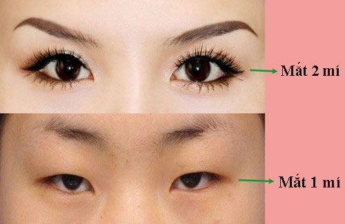 Mắt 2 mí đẹp hay xấu?