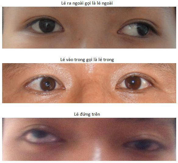 Mắt bị bù lệch ăn là gì?