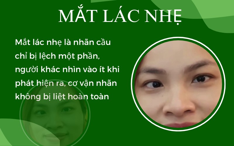 Mắt bị lác nhẹ: Nguyên nhân, triệu chứng và cách điều trị