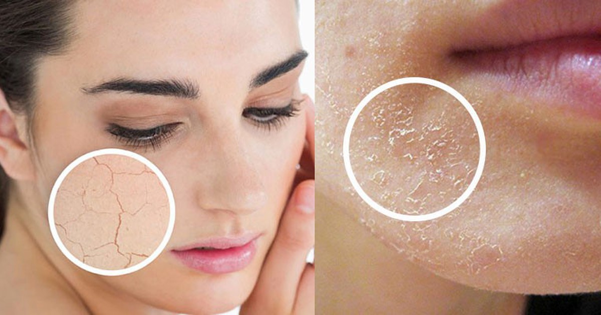 Mặt bị nẻ rát phải làm sao?