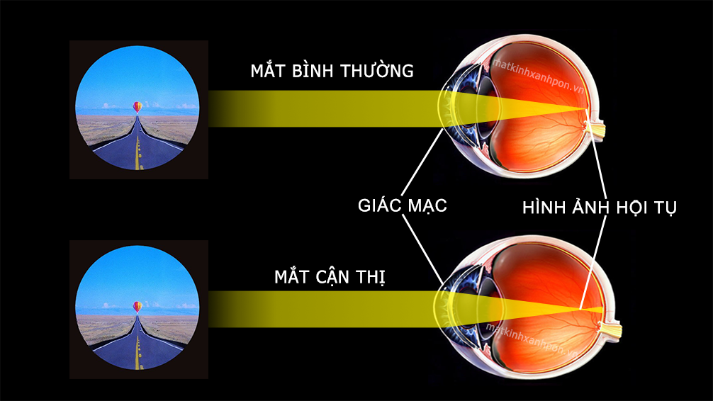 Mắt cận là gì?