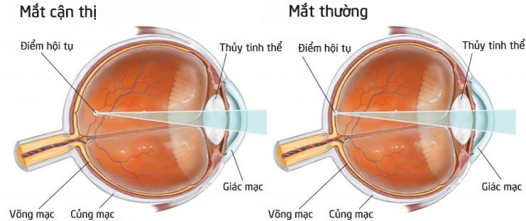 Mắt cận thị là mắt gì?