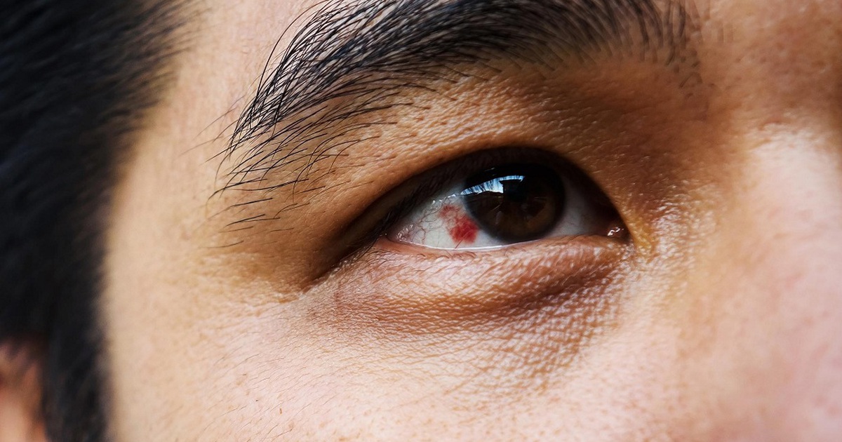 Mắt Có Đốm Đỏ: Nguyên Nhân, Triệu Chứng Và Cách Điều Trị