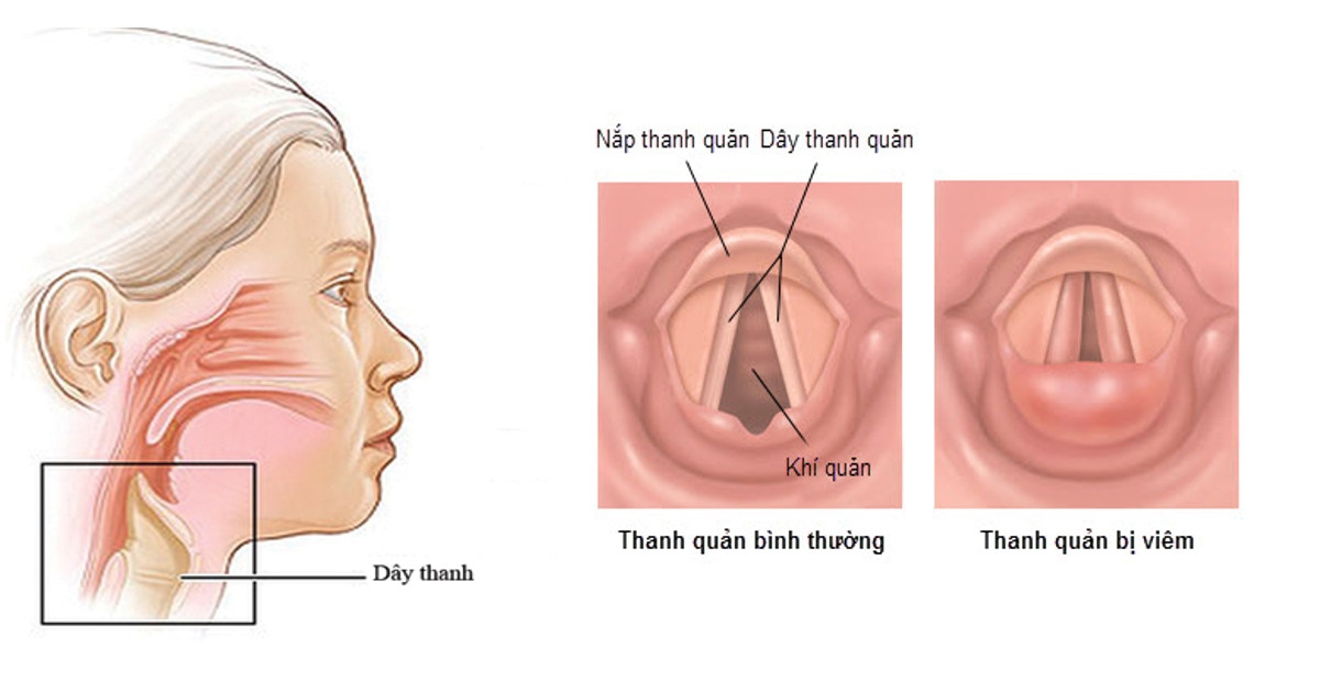 Mất Giọng Khản Tiếng: Nguyên Nhân, Triệu Chứng và Cách Điều Trị