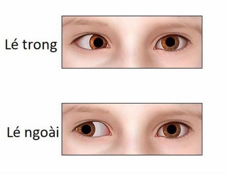 Mắt lác ngoài có chữa được không?