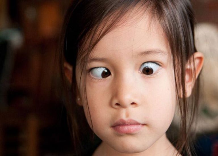 Mắt Lác Ở Trẻ Em: Nguyên Nhân, Triệu Chứng Và Cách Điều Trị