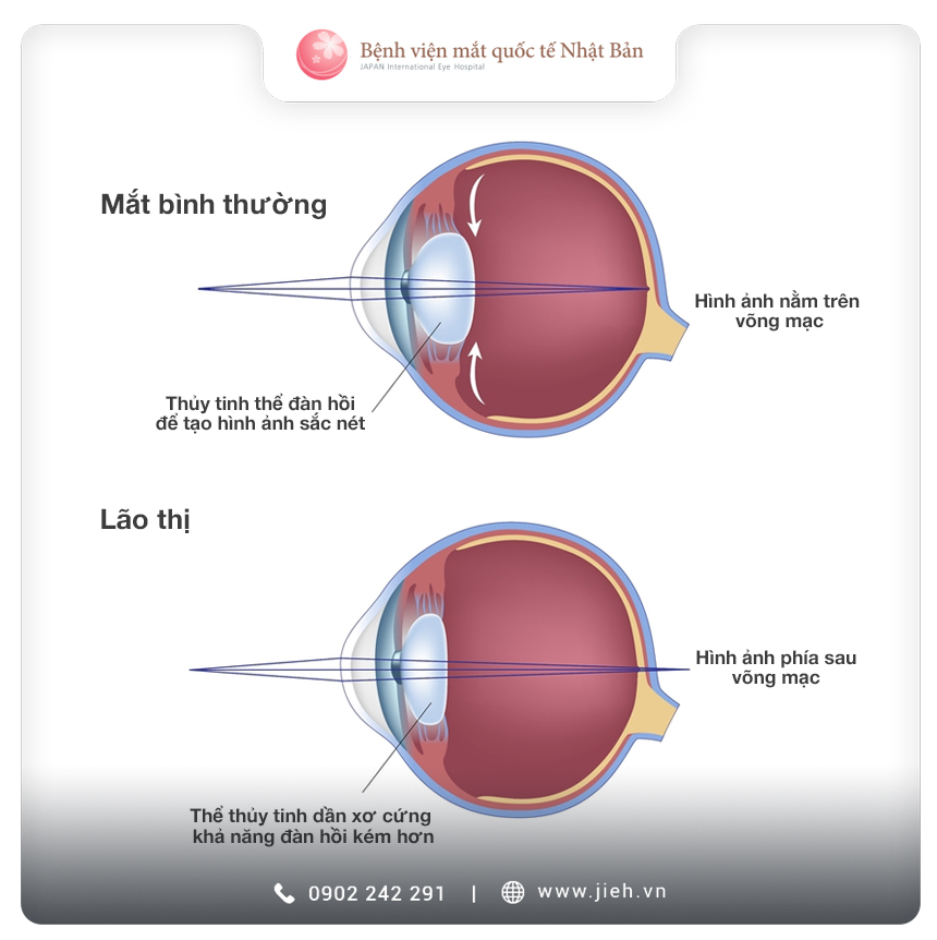 Mắt lão là mắt gì?